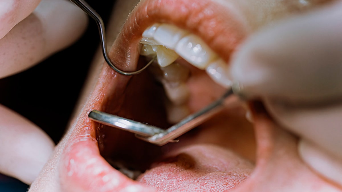 Super close view of a dental exam, we see the mouth and the small hand mirror